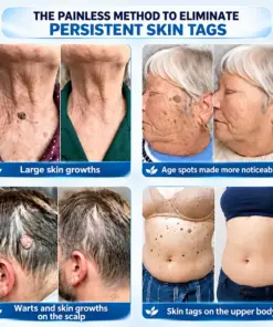 TERVENCE® 7-Day Cream for Skin Growths & Pigmentation Spots