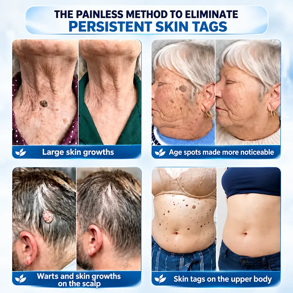 TERVENCE® 7-Day Cream for Skin Growths & Pigmentation Spots