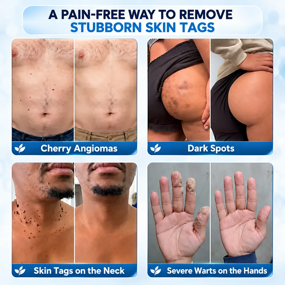 TERVENCE® 7-Day Cream for Skin Growths & Pigmentation Spots