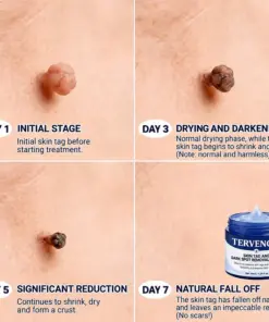TERVENCE® 7-Day Cream for Skin Growths & Pigmentation Spots