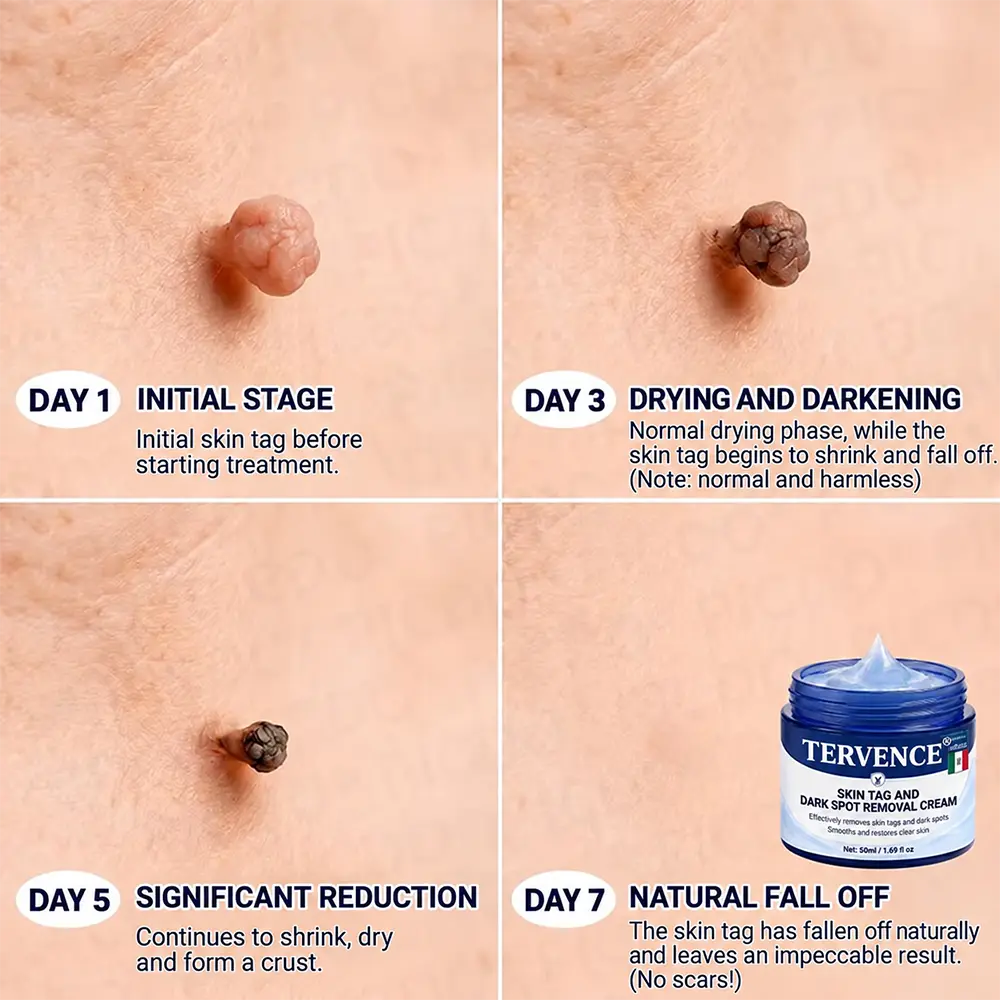 TERVENCE® 7-Day Cream for Skin Growths & Pigmentation Spots