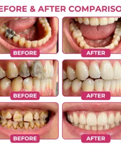 TERVENCE® Cavity-Repair Natural Enamel Filling Gel