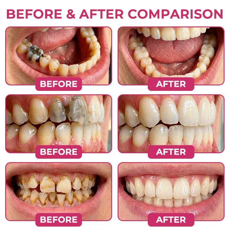 TERVENCE® Cavity-Repair Natural Enamel Filling Gel