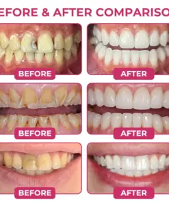 TERVENCE® Cavity-Repair Natural Enamel Filling Gel