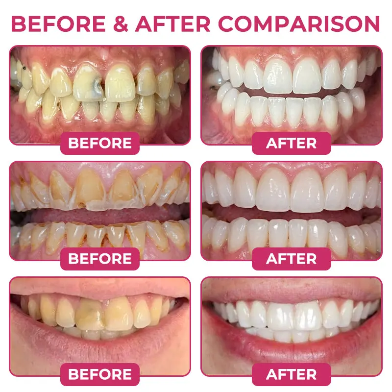 TERVENCE® Cavity-Repair Natural Enamel Filling Gel