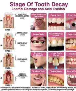 TERVENCE® Cavity-Repair Natural Enamel Filling Gel