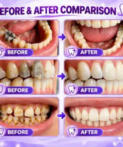 TERVENCE® DenPerm Cavity-Repair Natural Enamel Filling Gel