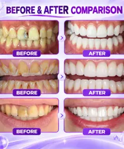 TERVENCE® DenPerm Cavity-Repair Natural Enamel Filling Gel