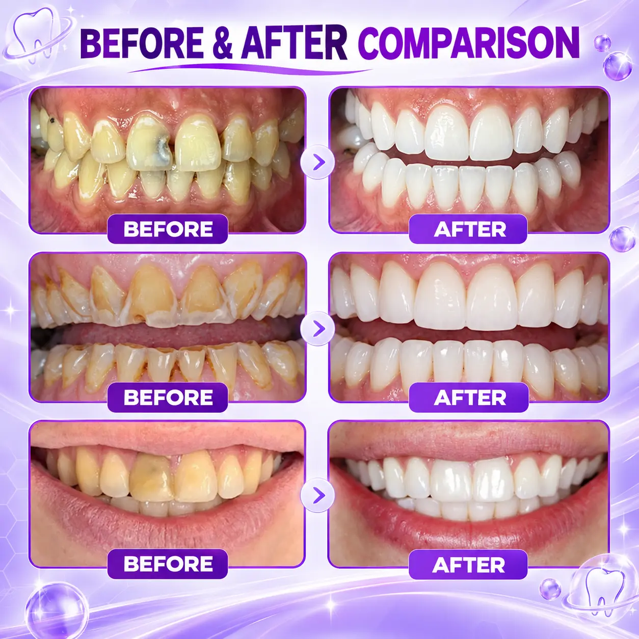TERVENCE® DenPerm Cavity-Repair Natural Enamel Filling Gel