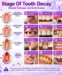 TERVENCE® DenPerm Cavity-Repair Natural Enamel Filling Gel