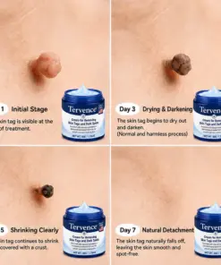Tervence® 7-Day Skin Tag & Spot Care Cream
