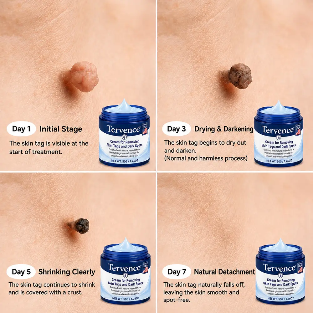 Tervence® 7-Day Skin Tag & Spot Care Cream